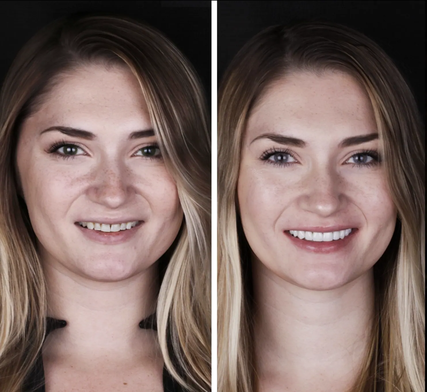 Ortodoncia · Alineadores