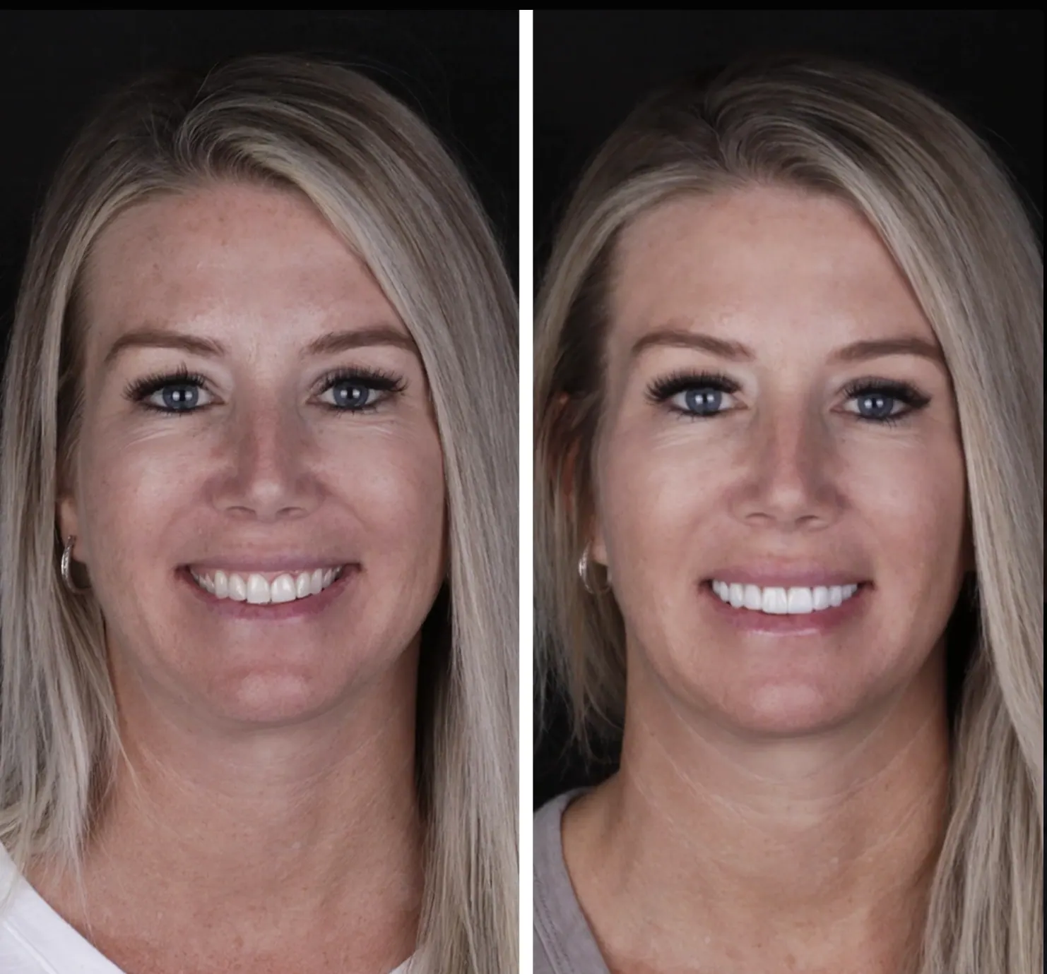 Carillas · Diseño de Sonrisa: caso real de diseño de sonrisa antes y después en Clínica Doctores Romero Madrid