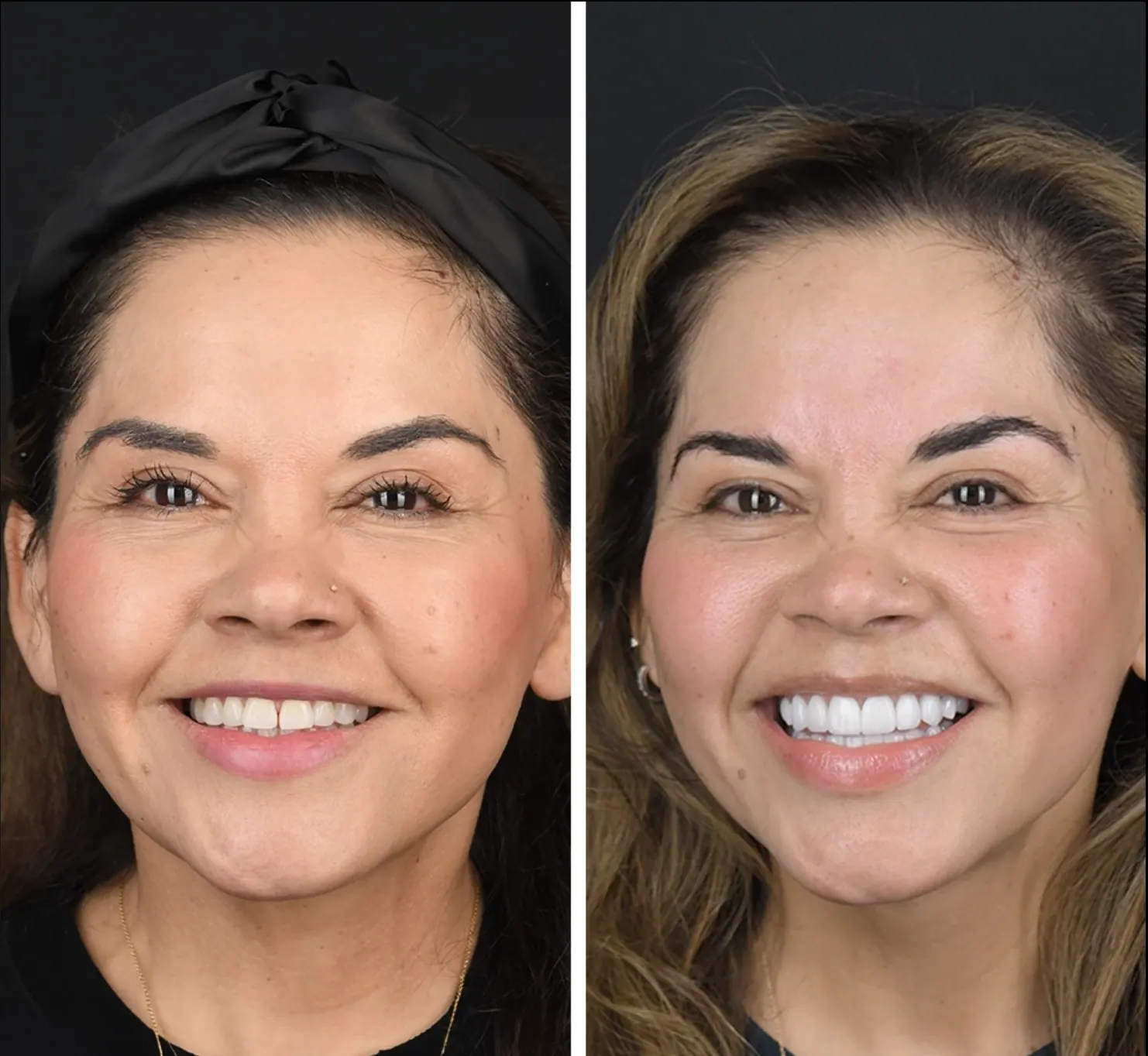 Ortodoncia · Invisalign: caso real de invisalign antes y después en Clínica Doctores Romero Madrid