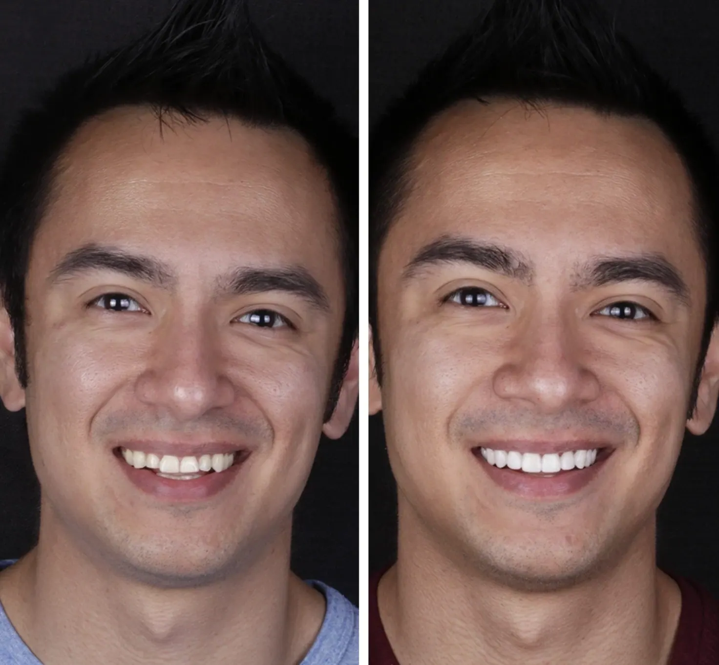 Implantes · Straumann