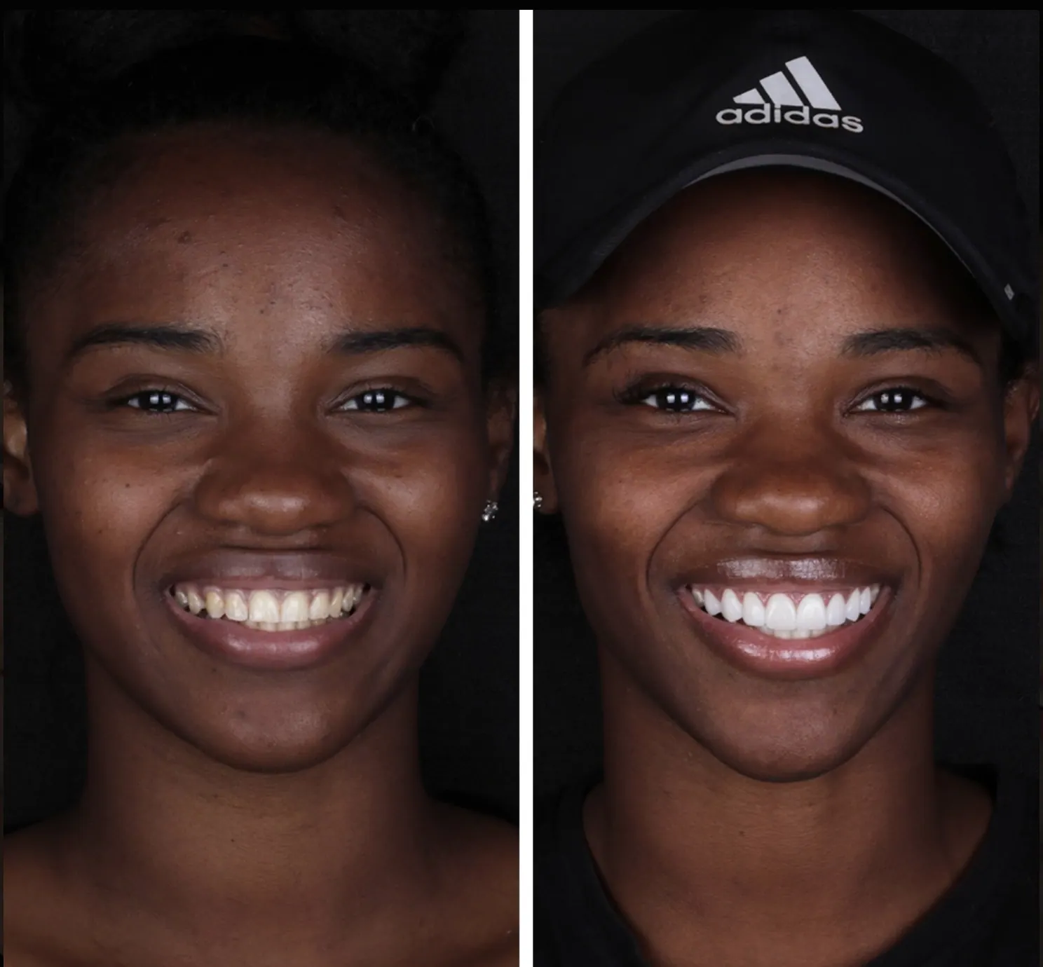 Carillas · Estética Dental