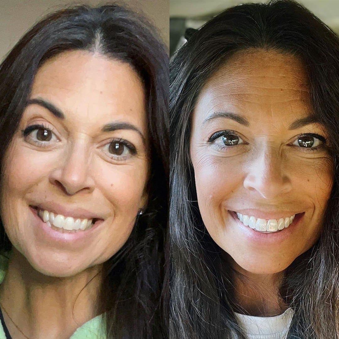 Estética Dental · Sonrisa Natural: caso real de estética dental antes y después en Clínica Doctores Romero Madrid