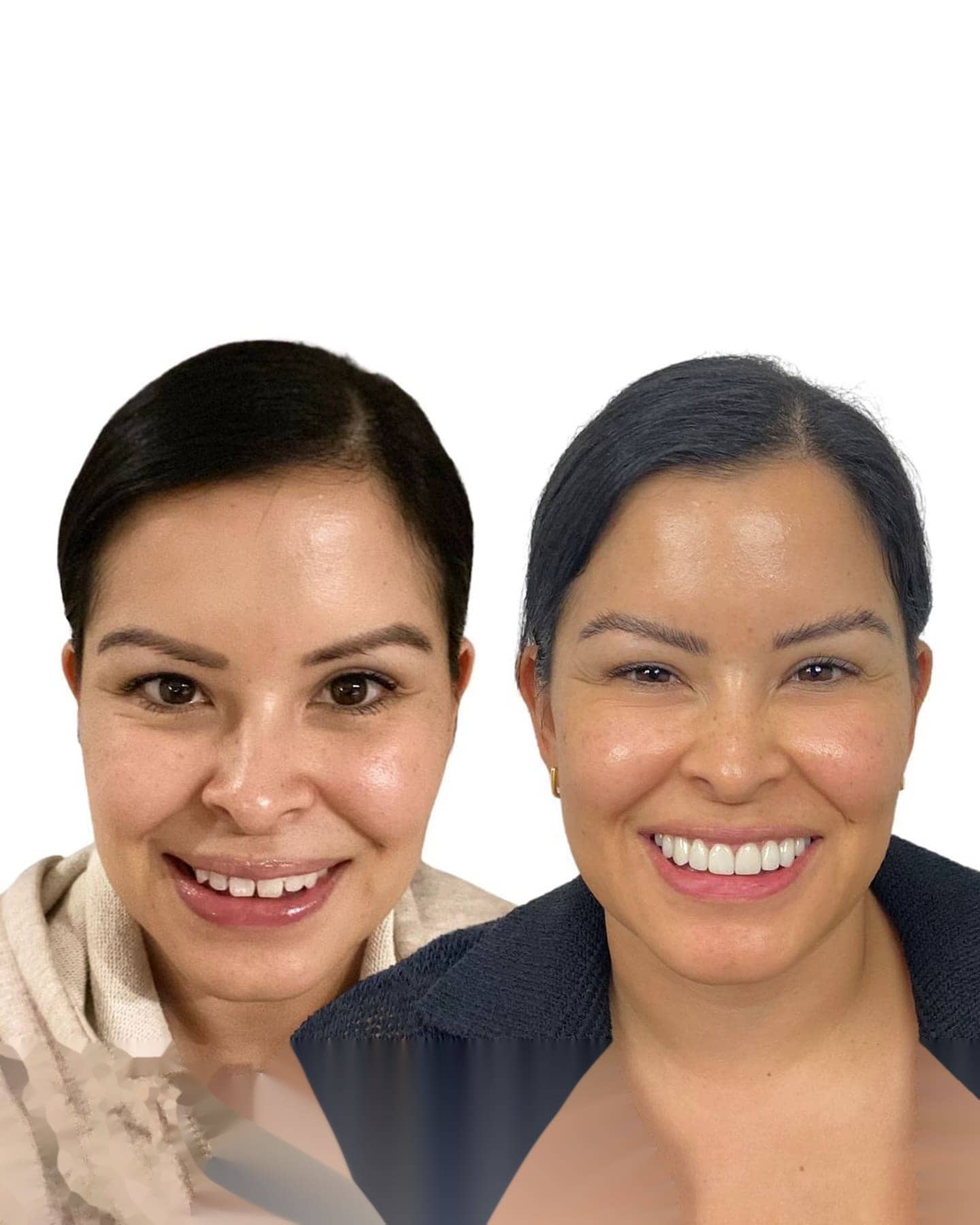 Comparativa de métodos de blanqueamiento dental en casa