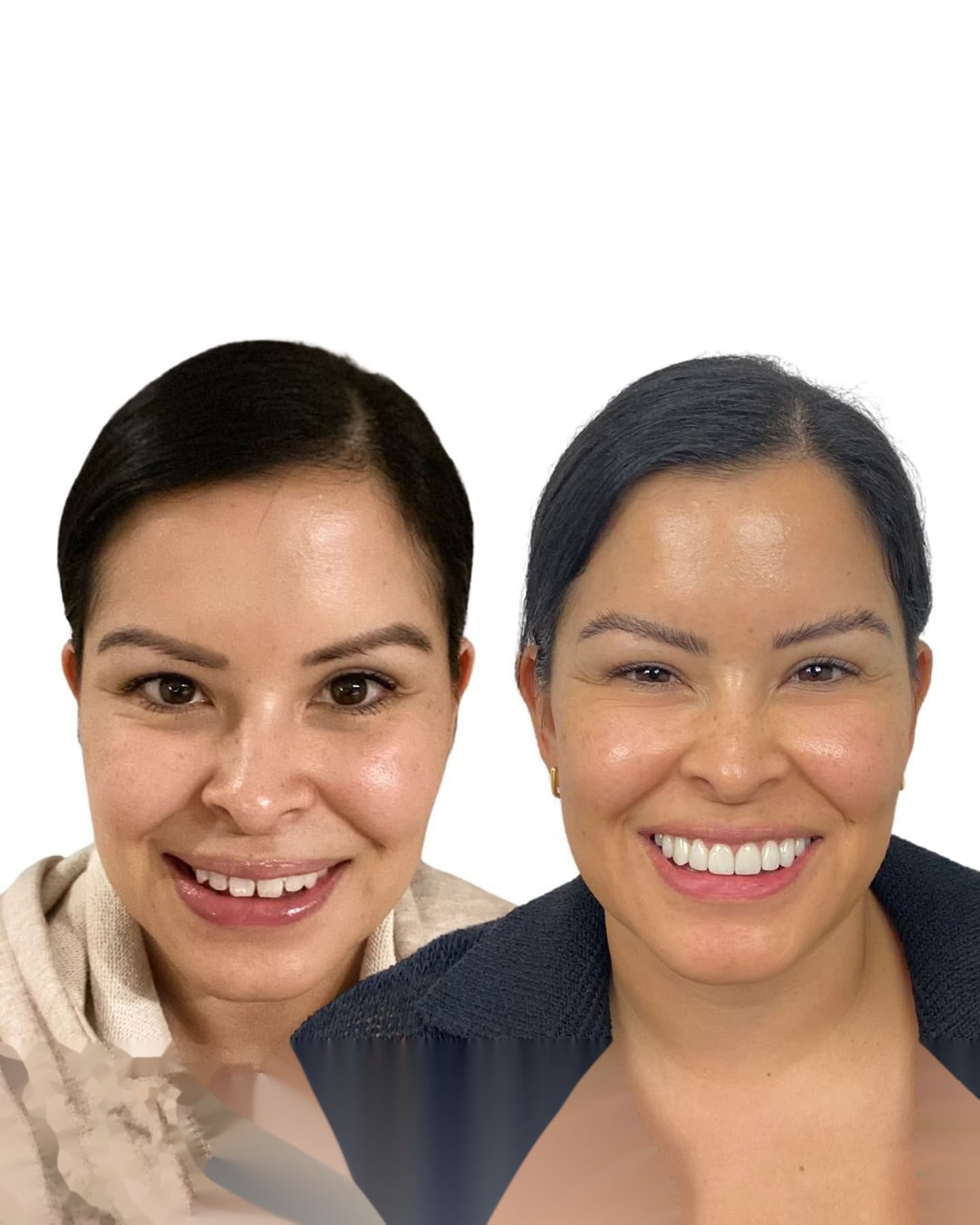 Comparativa de métodos de blanqueamiento dental en casa