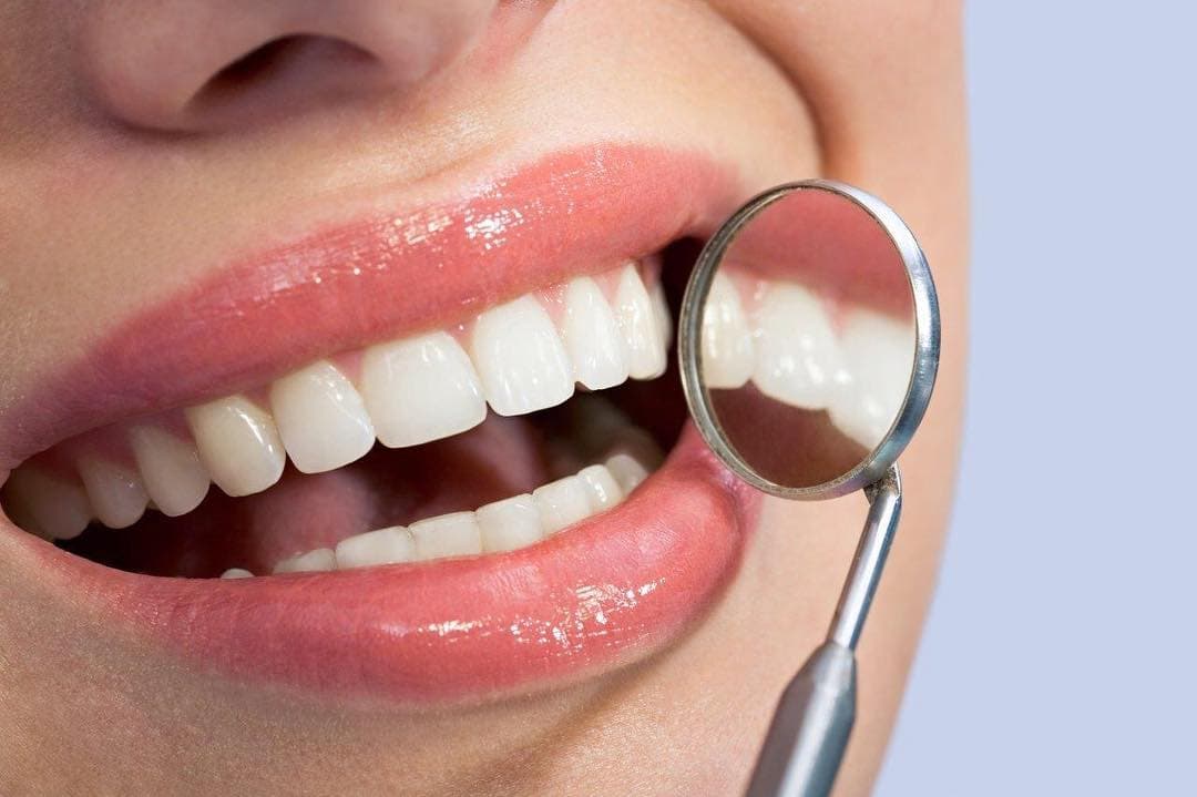 Blanqueamiento dental Madrid: precio y qué incluye