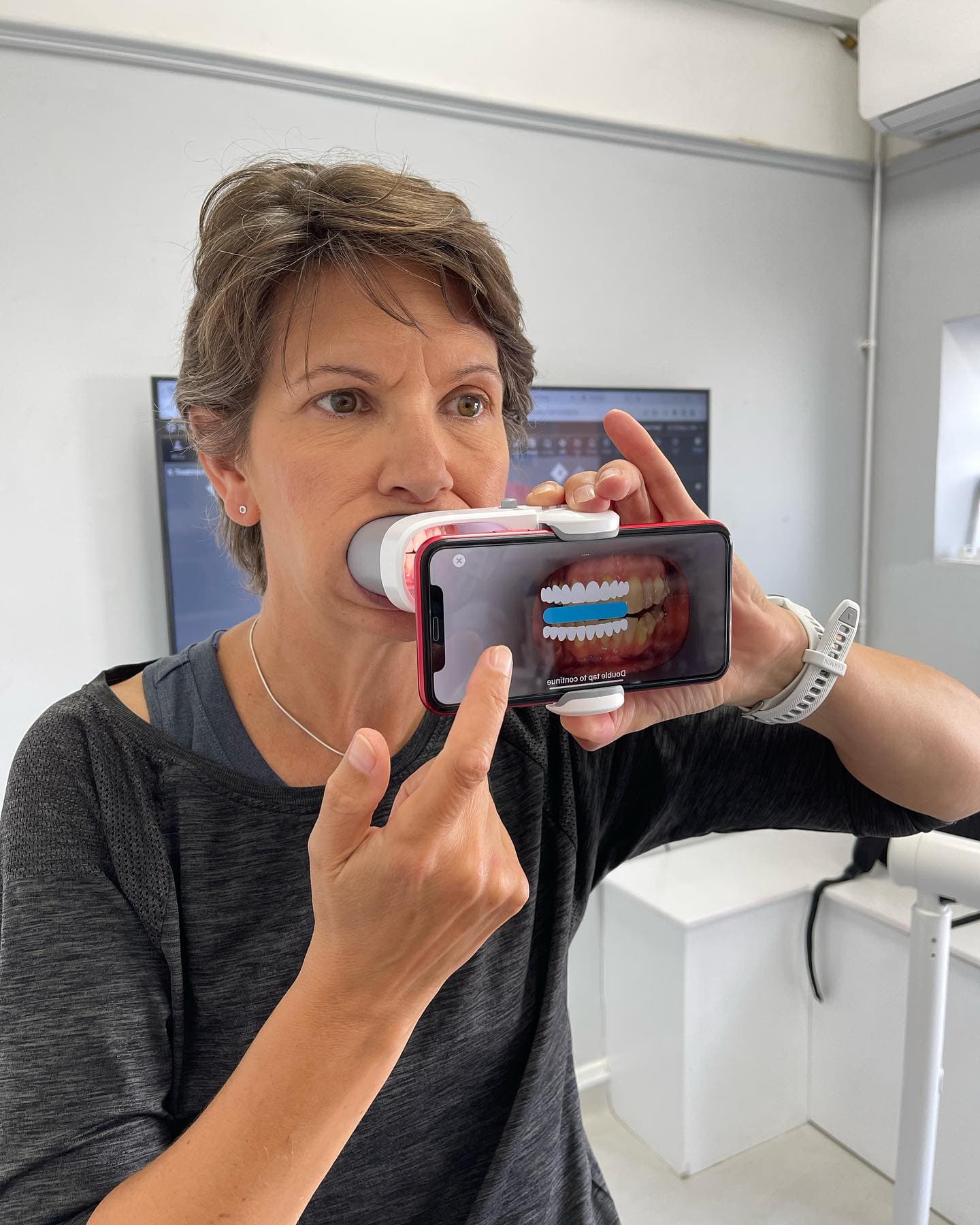 Blanqueamiento Profesional vs Casero | Doctores Romero