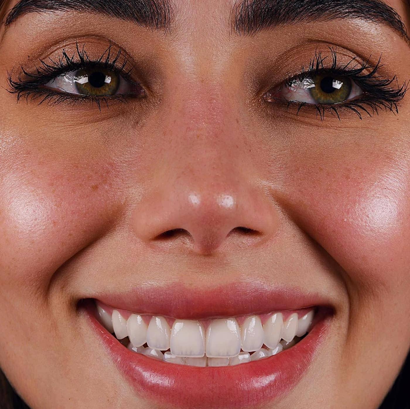 Sonrisa con carillas dentales para pacientes de Arganzuela
