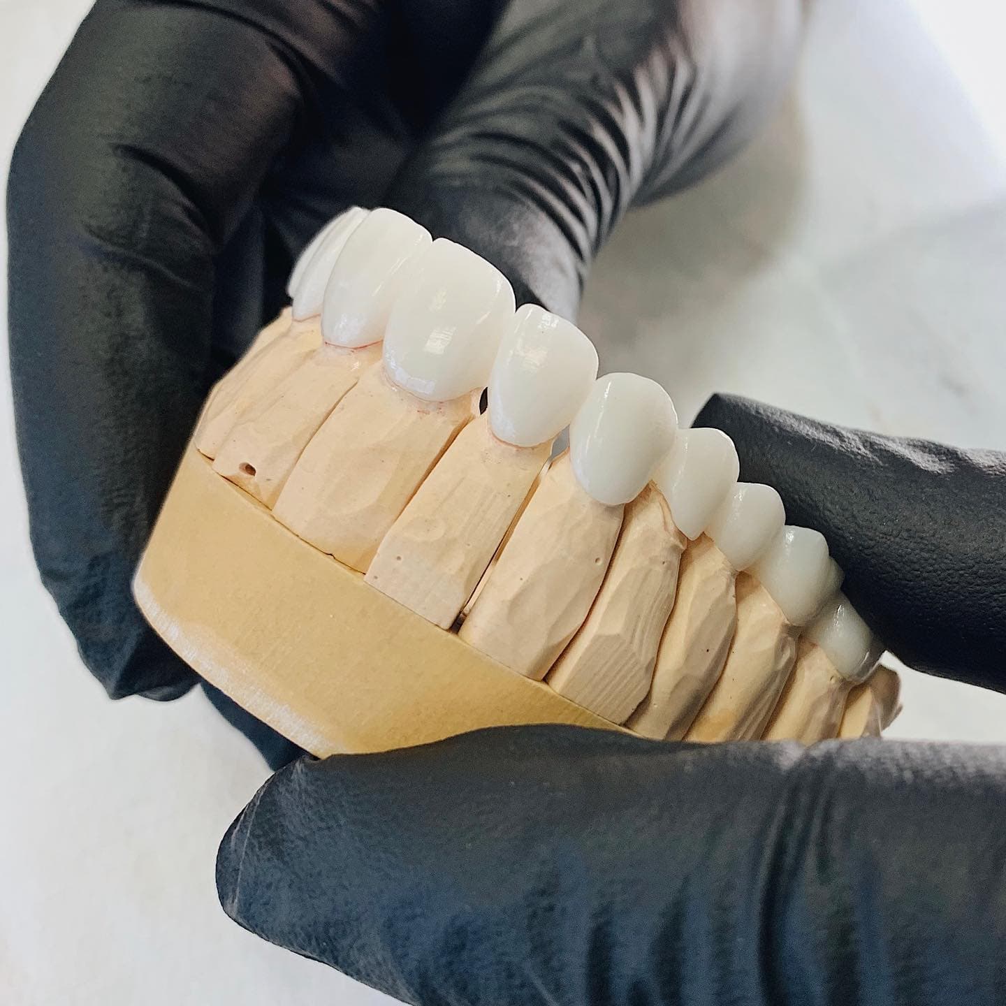 Carillas Porcelana vs Zirconio — Dr. Diego, 30+ Años