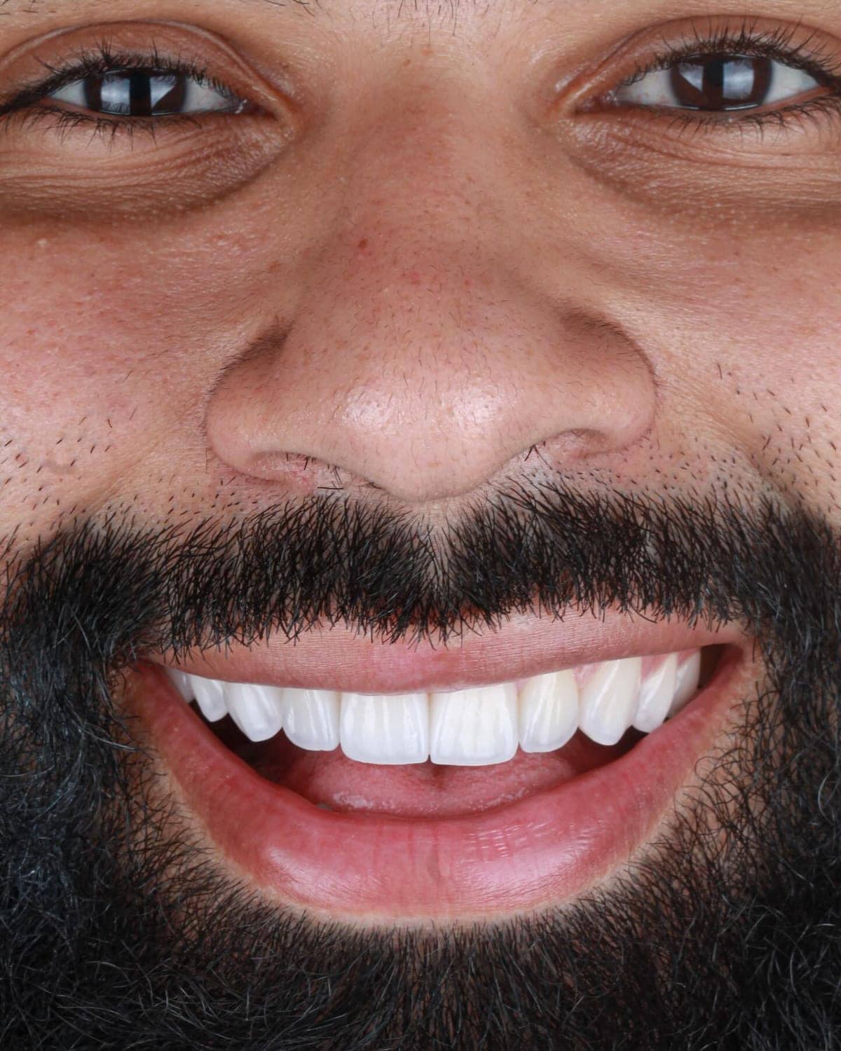 Detalle de sonrisa natural para carillas sin tallado en Madrid