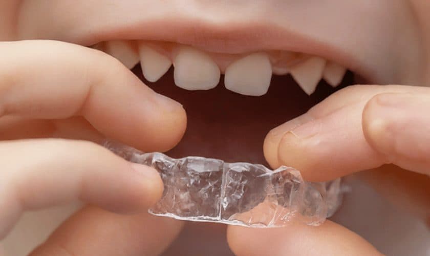 ¿Cuánto Dura la Ortodoncia? Guía | Doctores Romero