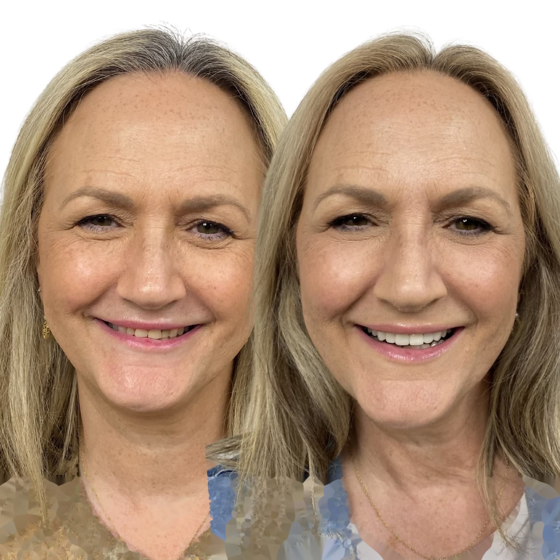 Férula de descarga personalizada en Madrid — Clínica Doctores Romero