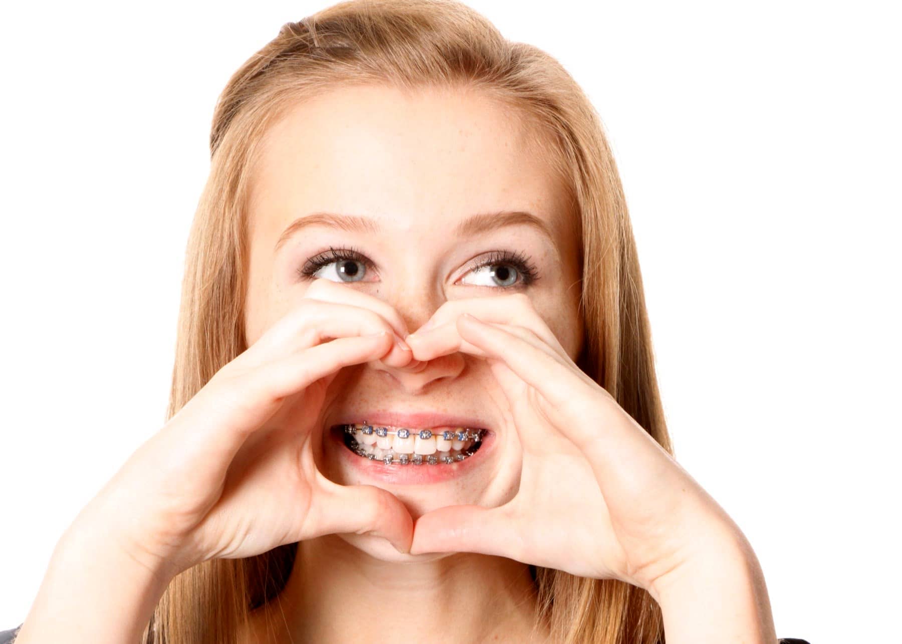 Sonrisa con brackets estéticos durante los primeros días de ortodoncia