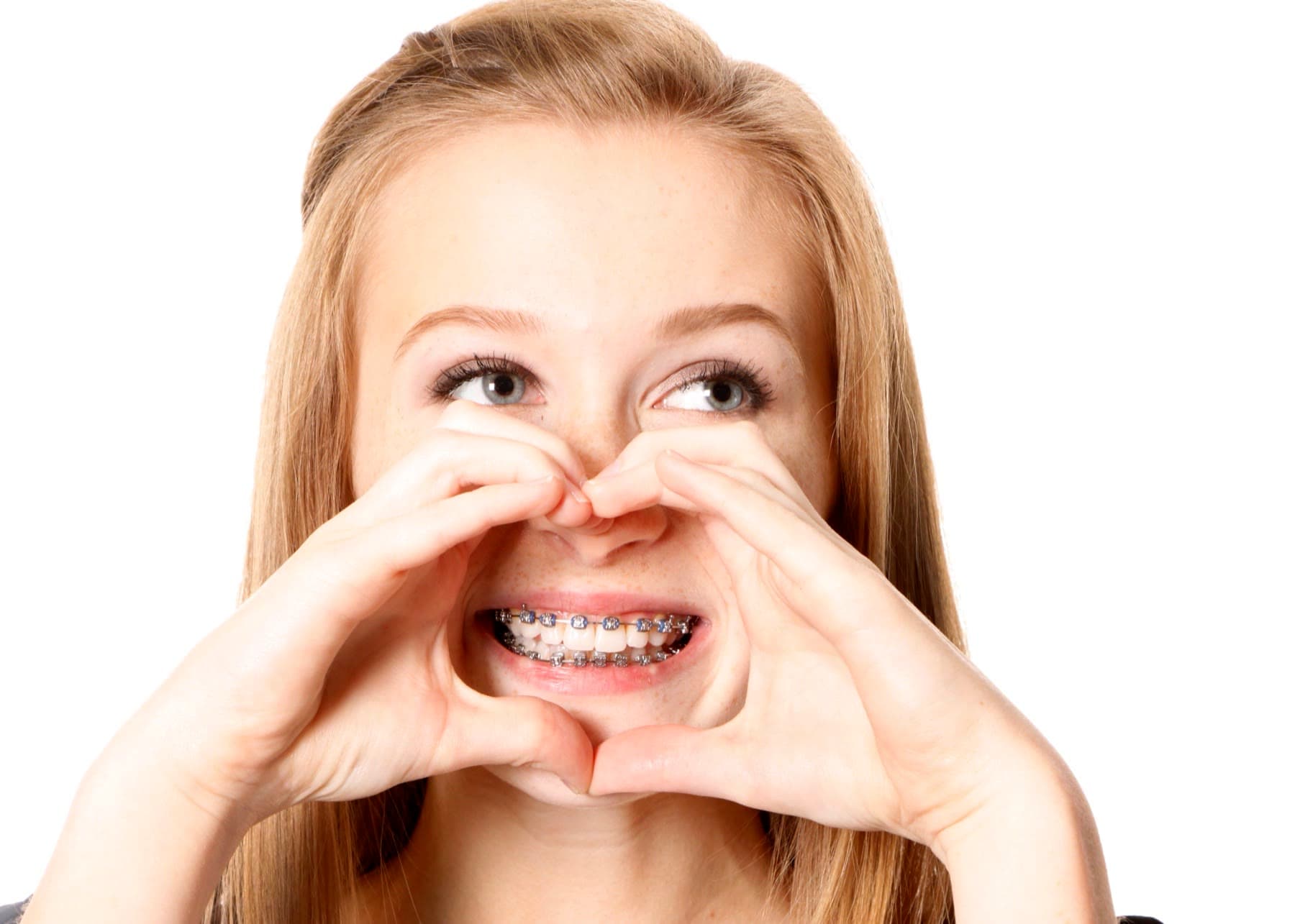 Sonrisa con brackets estéticos durante los primeros días de ortodoncia