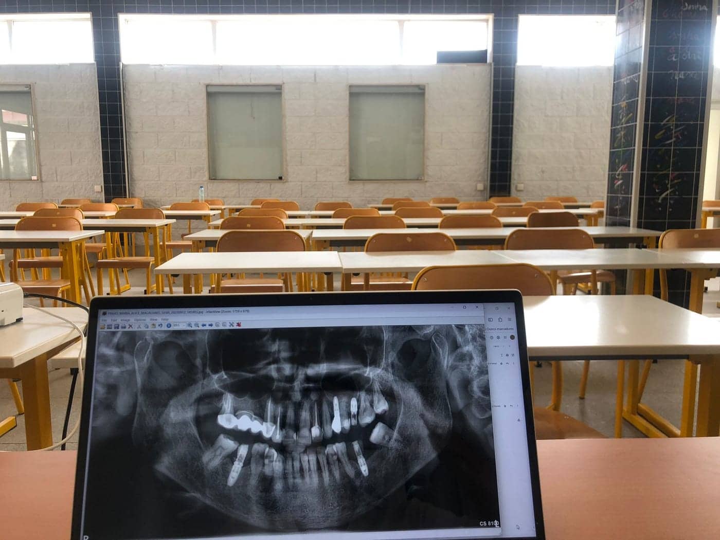 Planificación digital de implantes dentales cerca de Hortaleza