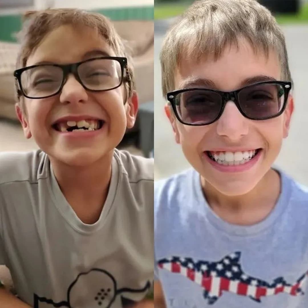 Antes y después de ortodoncia infantil con sonrisa natural