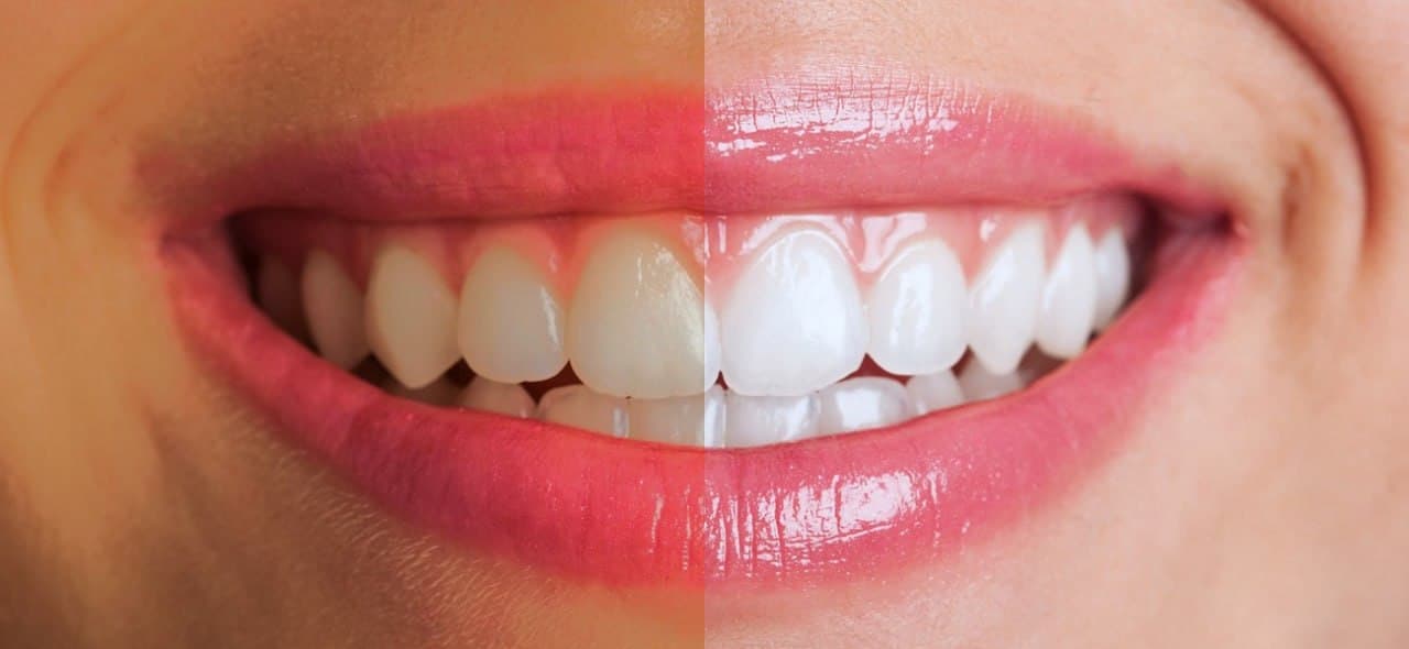 Antes y después de blanqueamiento dental