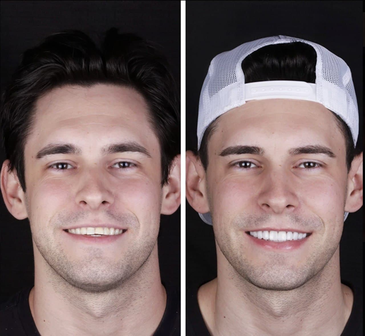 Antes y después de estética dental en hombre joven con sonrisa natural