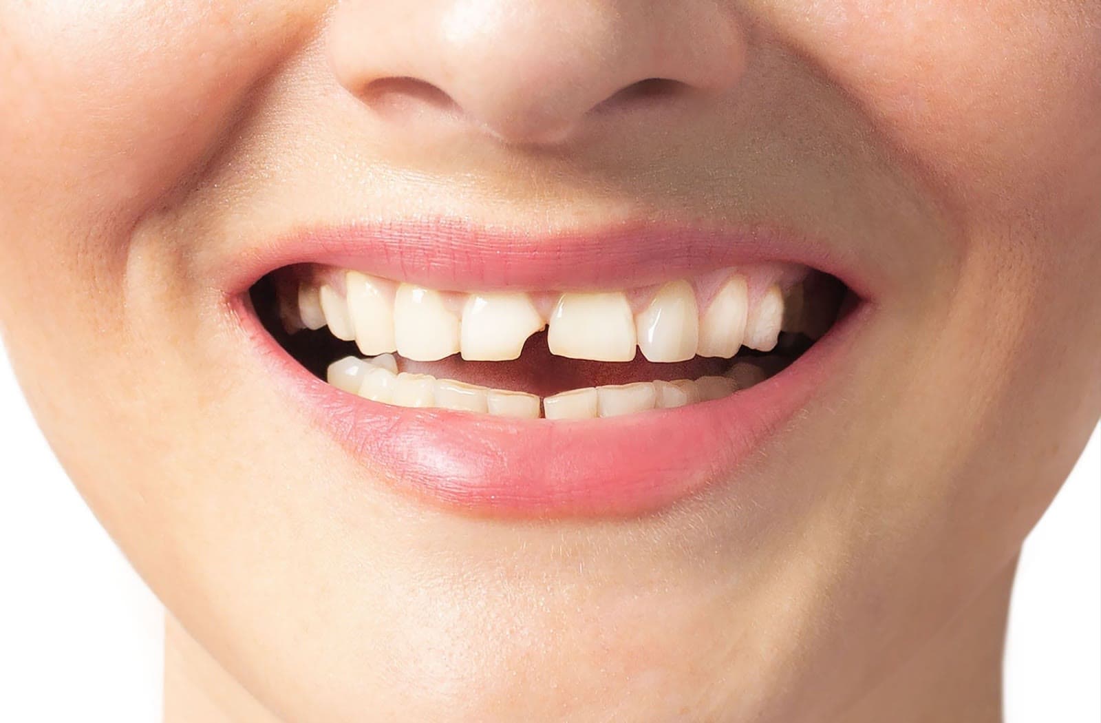 Sonrisa natural como referencia para valorar proporción, color y estética dental