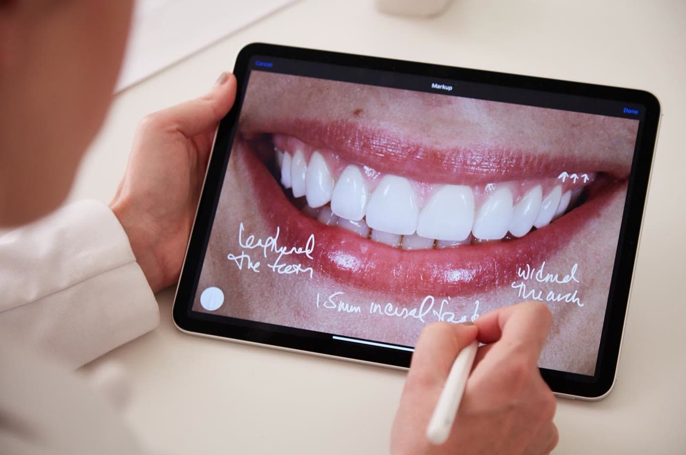 Carillas dentales y blanqueamiento dental en Carabanchel