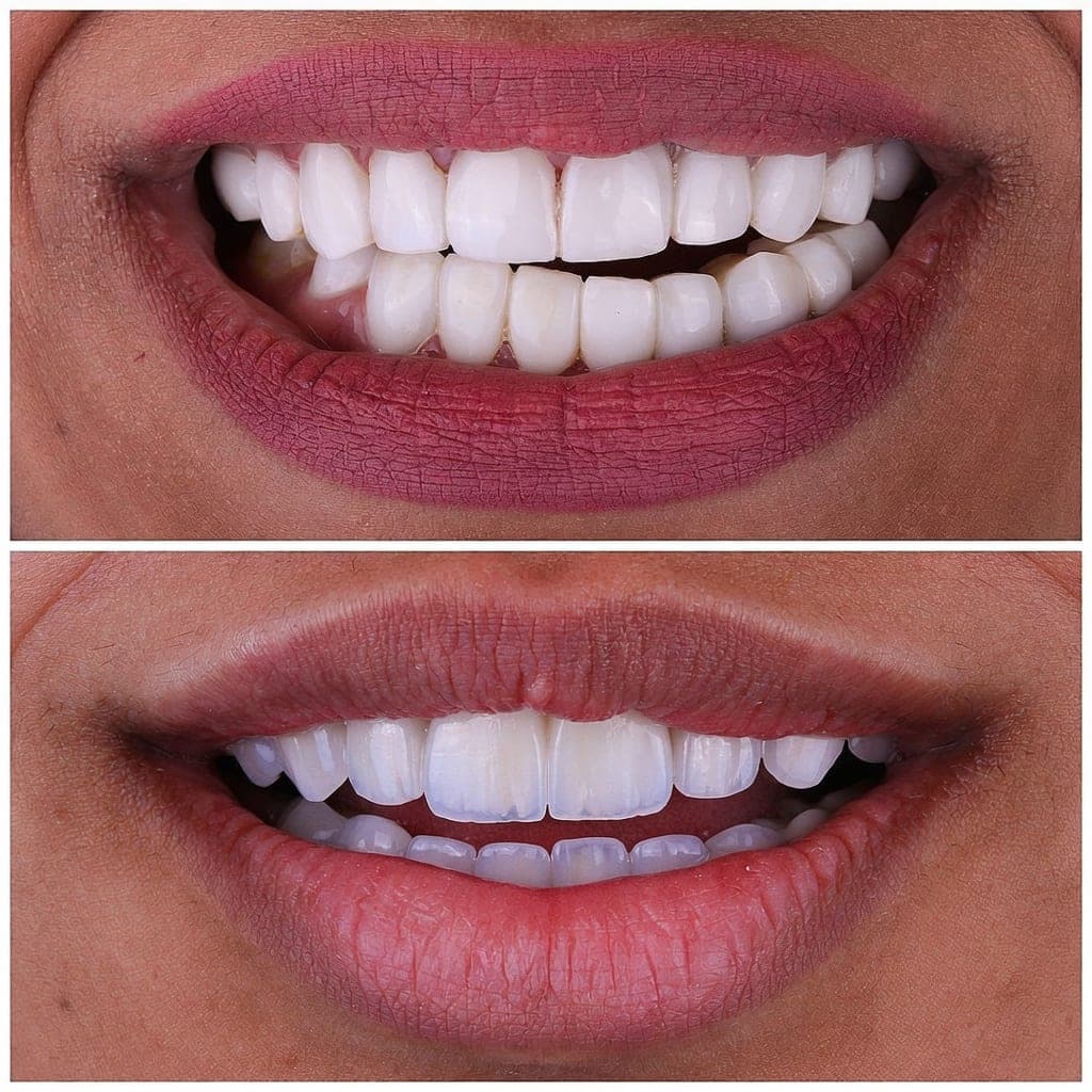 Comparativa estética de sonrisa antes de decidir si ponerte carillas o hacerte un blanqueamiento