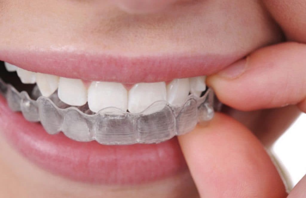 Detalle de un alineador transparente colocado sobre los dientes