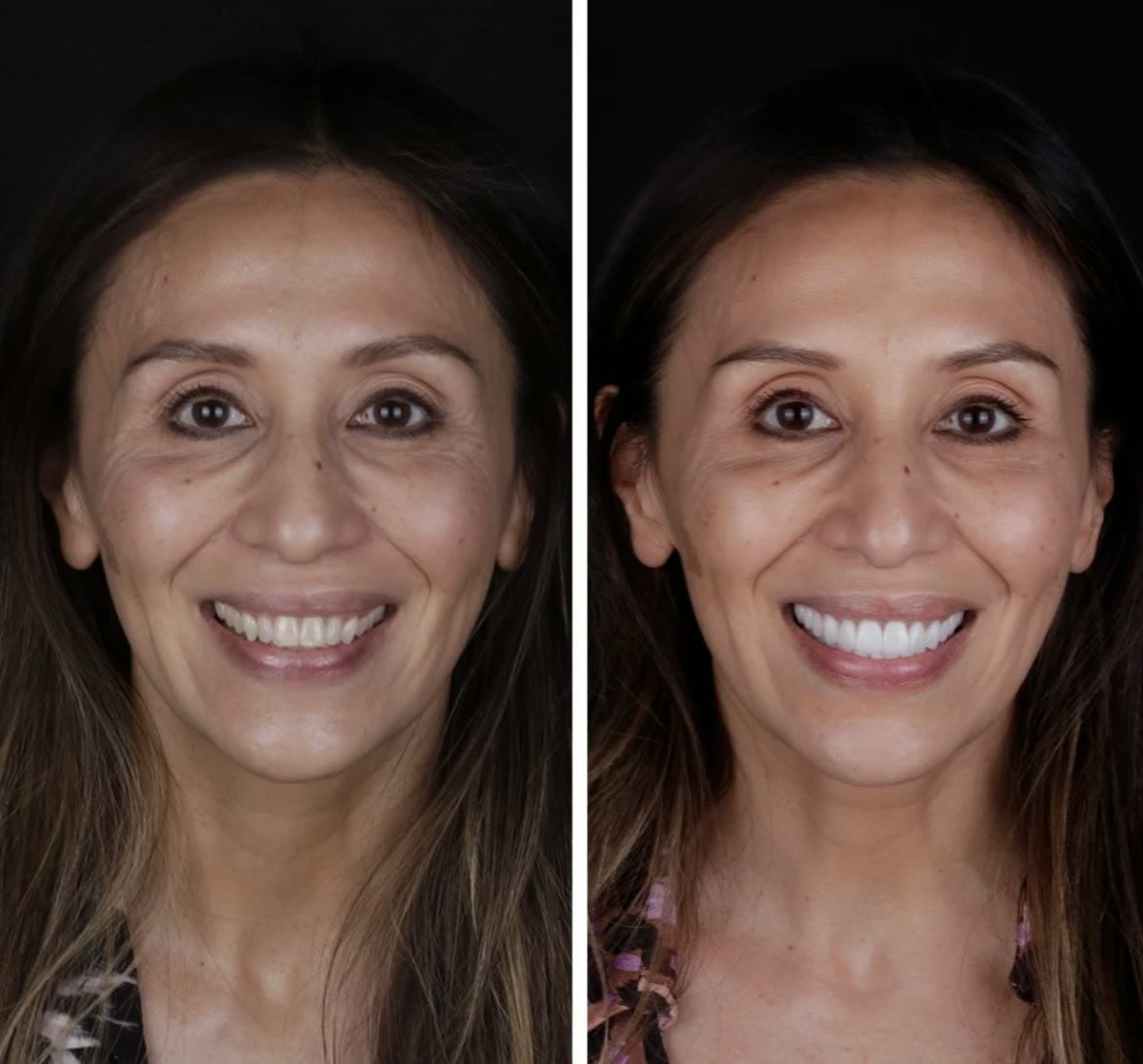 Estética Dental · Sonrisa Luminosa: caso real de estética dental antes y después en Clínica Doctores Romero Madrid