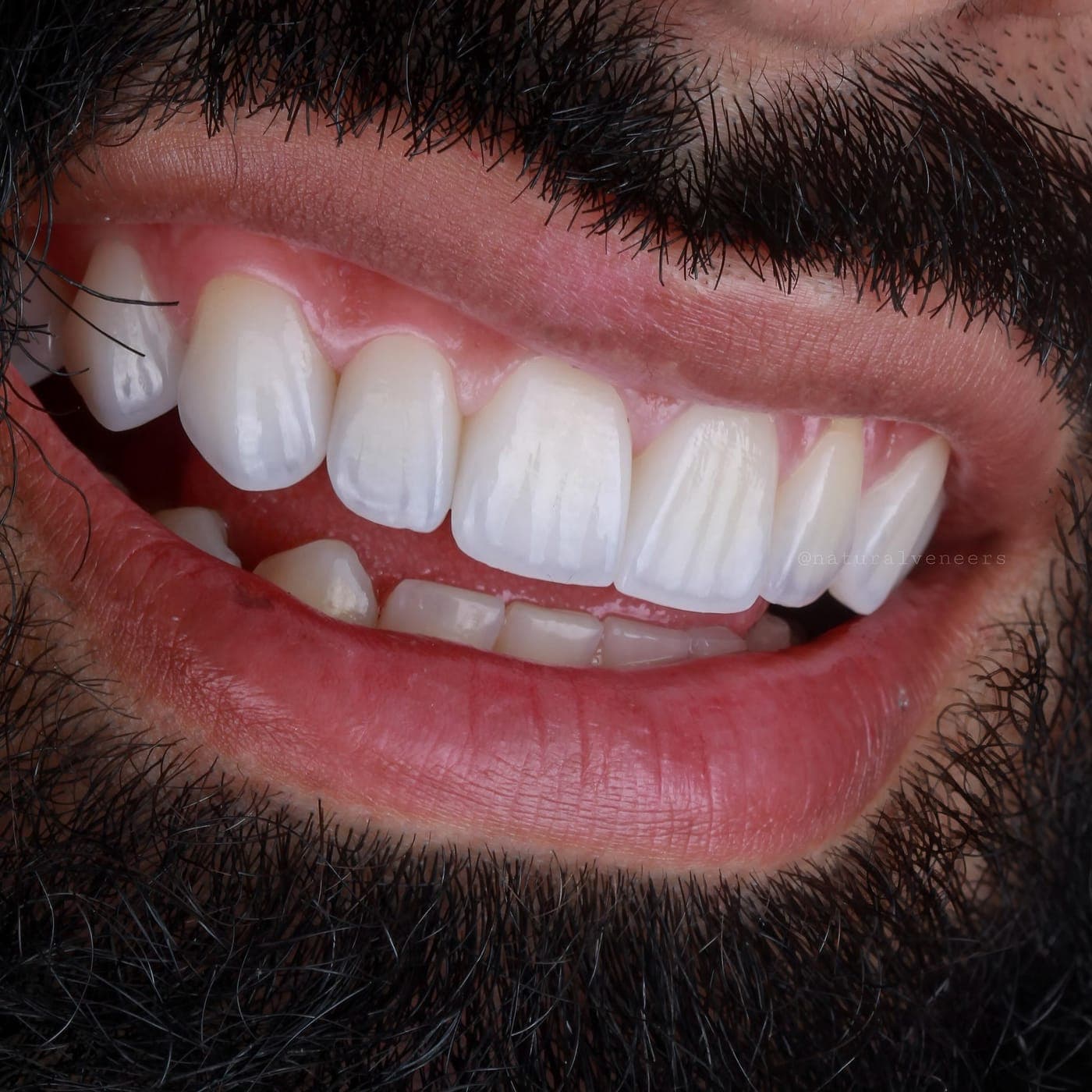 Sonrisa natural tras valoración estética en Clínica Doctores Romero