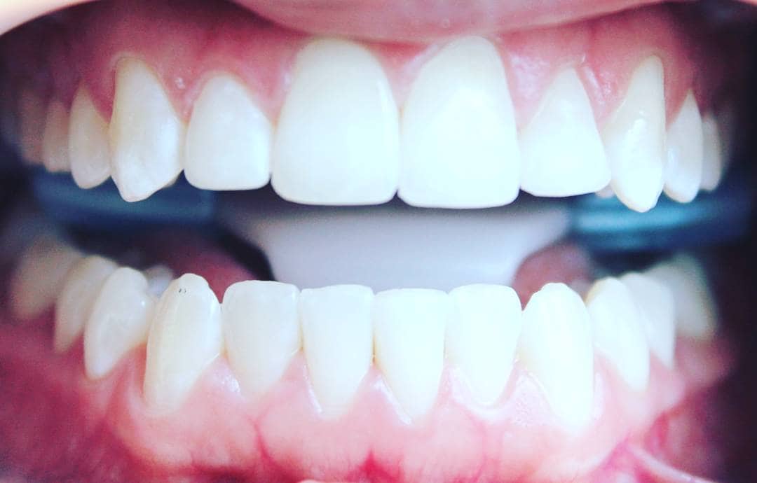 Paciente en revisión de implantes dentales en Madrid