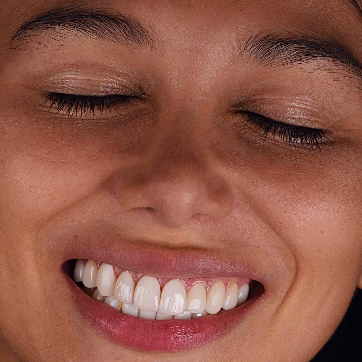 Carillas dentales de aspecto natural valoradas por Dr. Diego Romero en Barrio de Salamanca