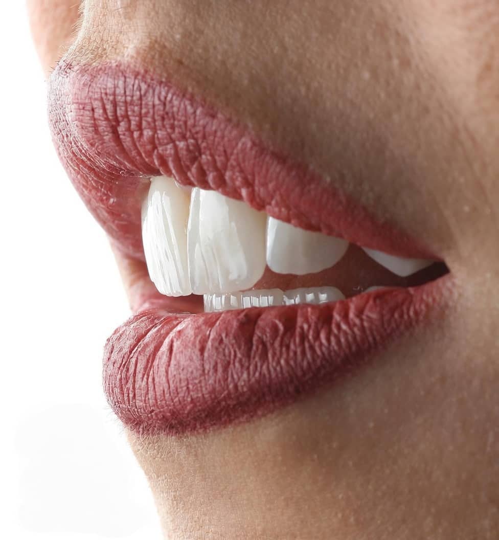 Sonrisa natural y proporcionada para estética dental conservadora