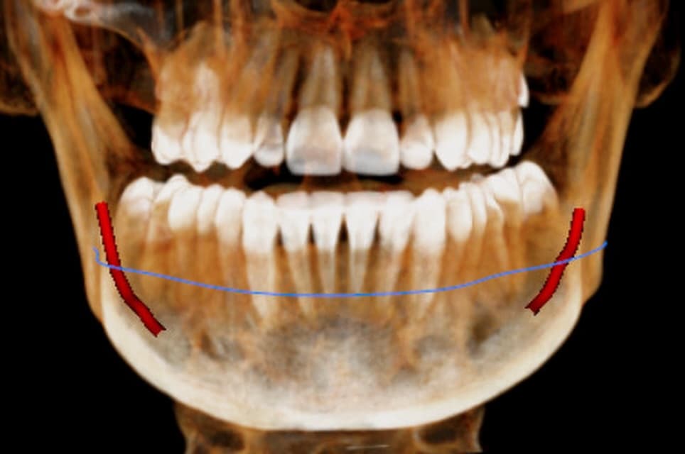 Planificación dental 3D antes de implantes y cirugía