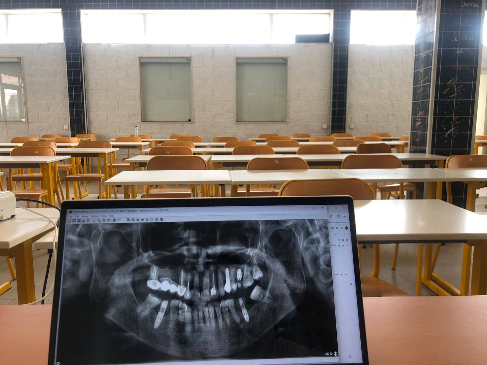 Planificación digital de implantes dentales antes de decidir el tratamiento