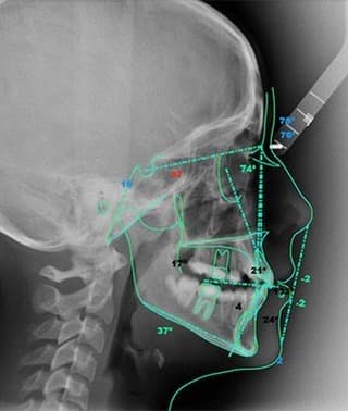 Radiografía dental para valorar una endodoncia en Madrid