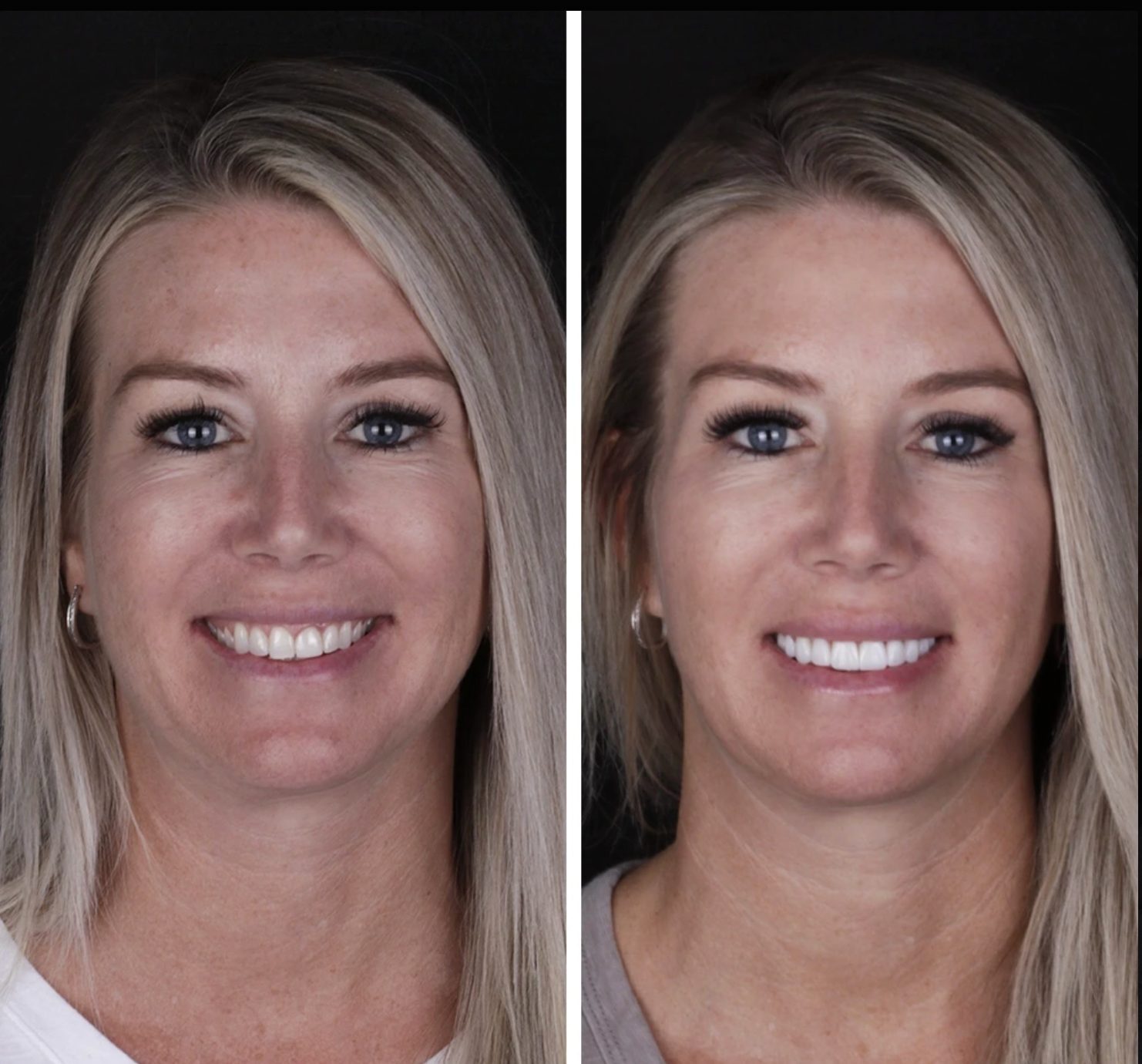 Antes y después Carillas · Transformación Natural — Clínica Doctores Romero