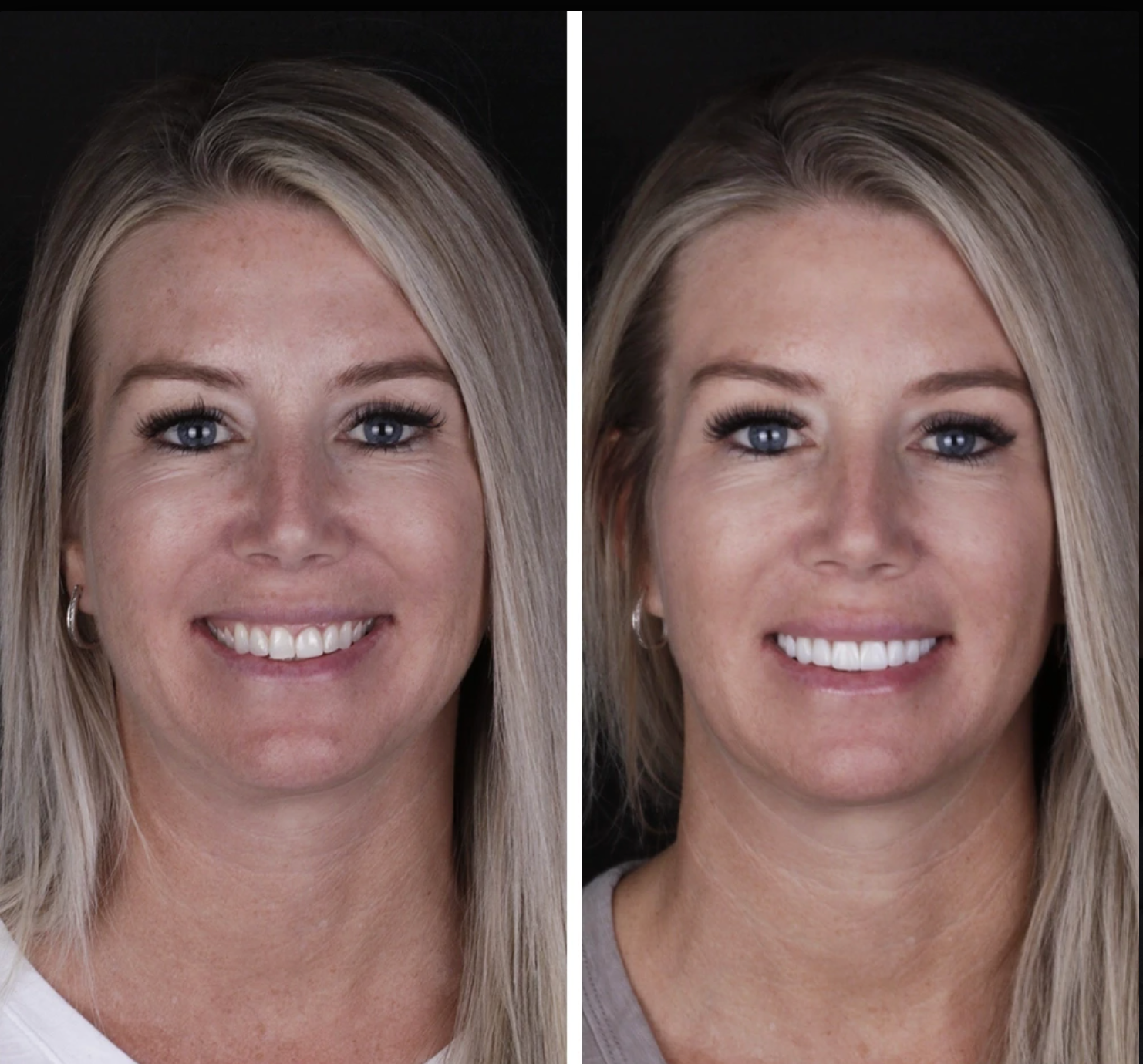 Antes y después Carillas · Diseño de Sonrisa — Clínica Doctores Romero