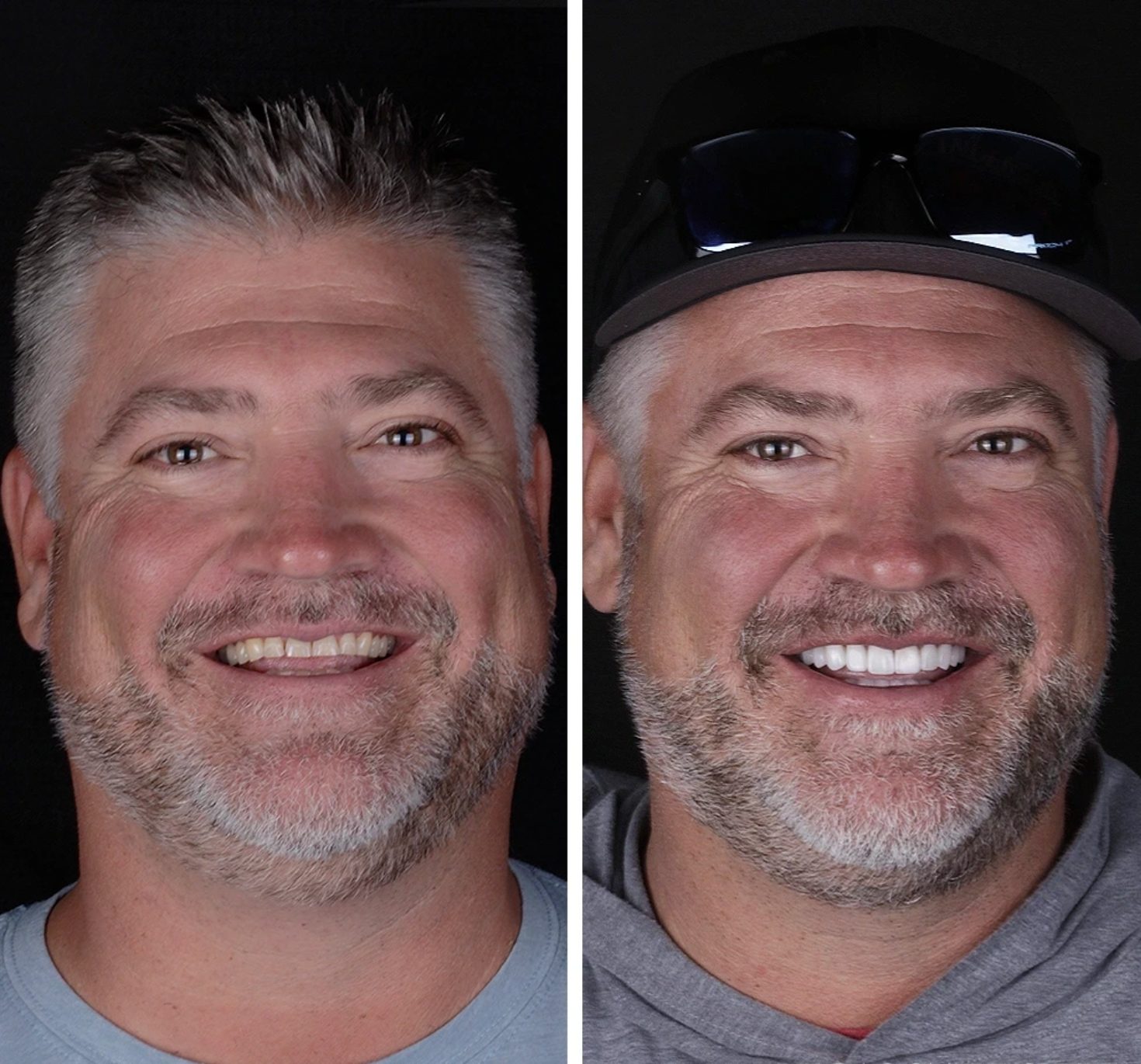 Antes y después Ortodoncia · Sonrisa Masculina — Clínica Doctores Romero