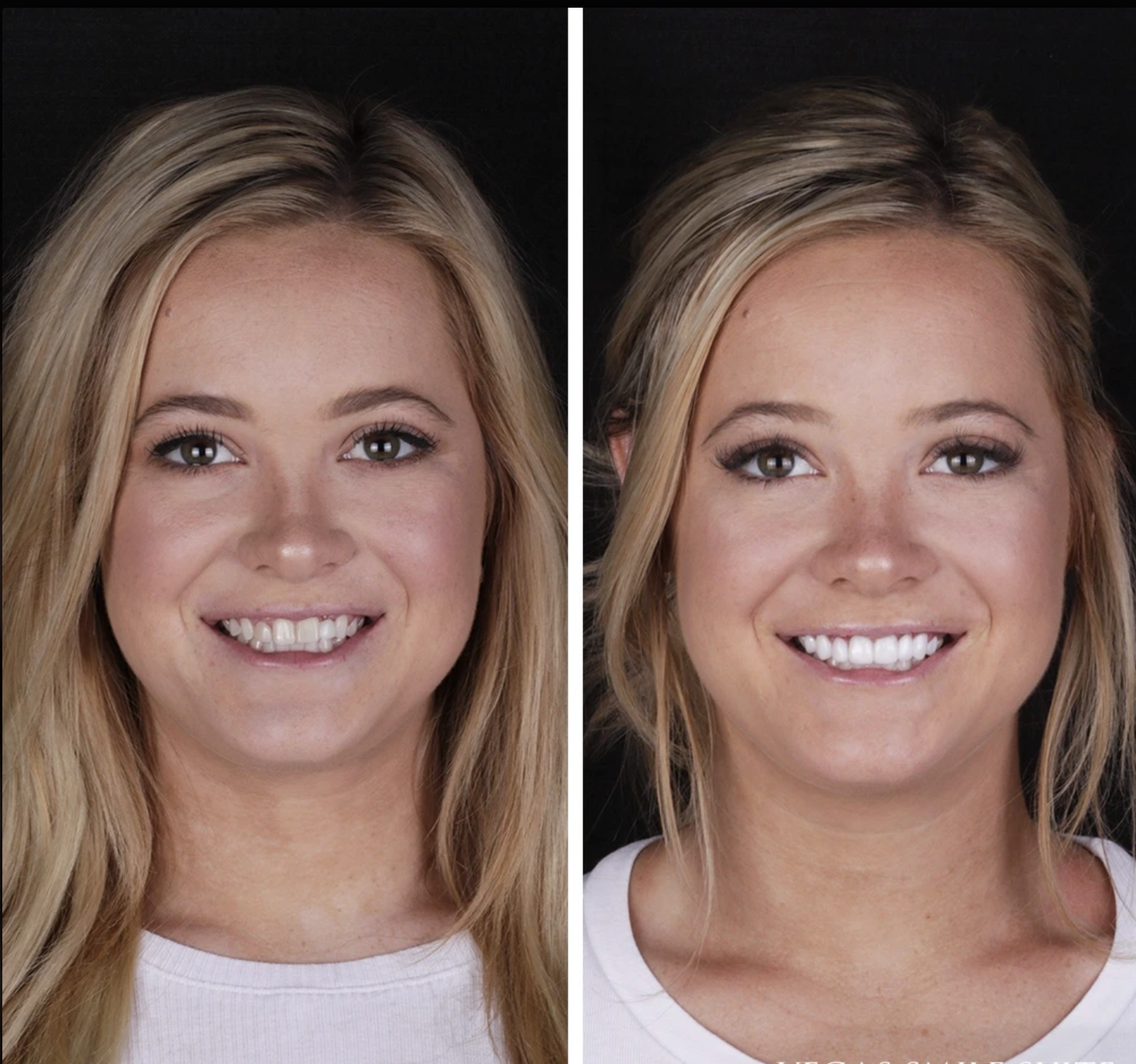 Antes y después Carillas · Sonrisa Hollywood — Clínica Doctores Romero