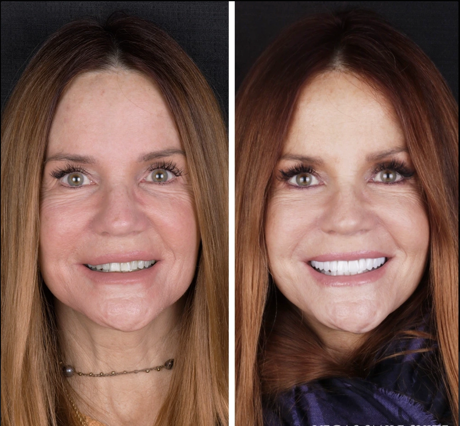 Antes y después Carillas · Sonrisa Natural — Clínica Doctores Romero