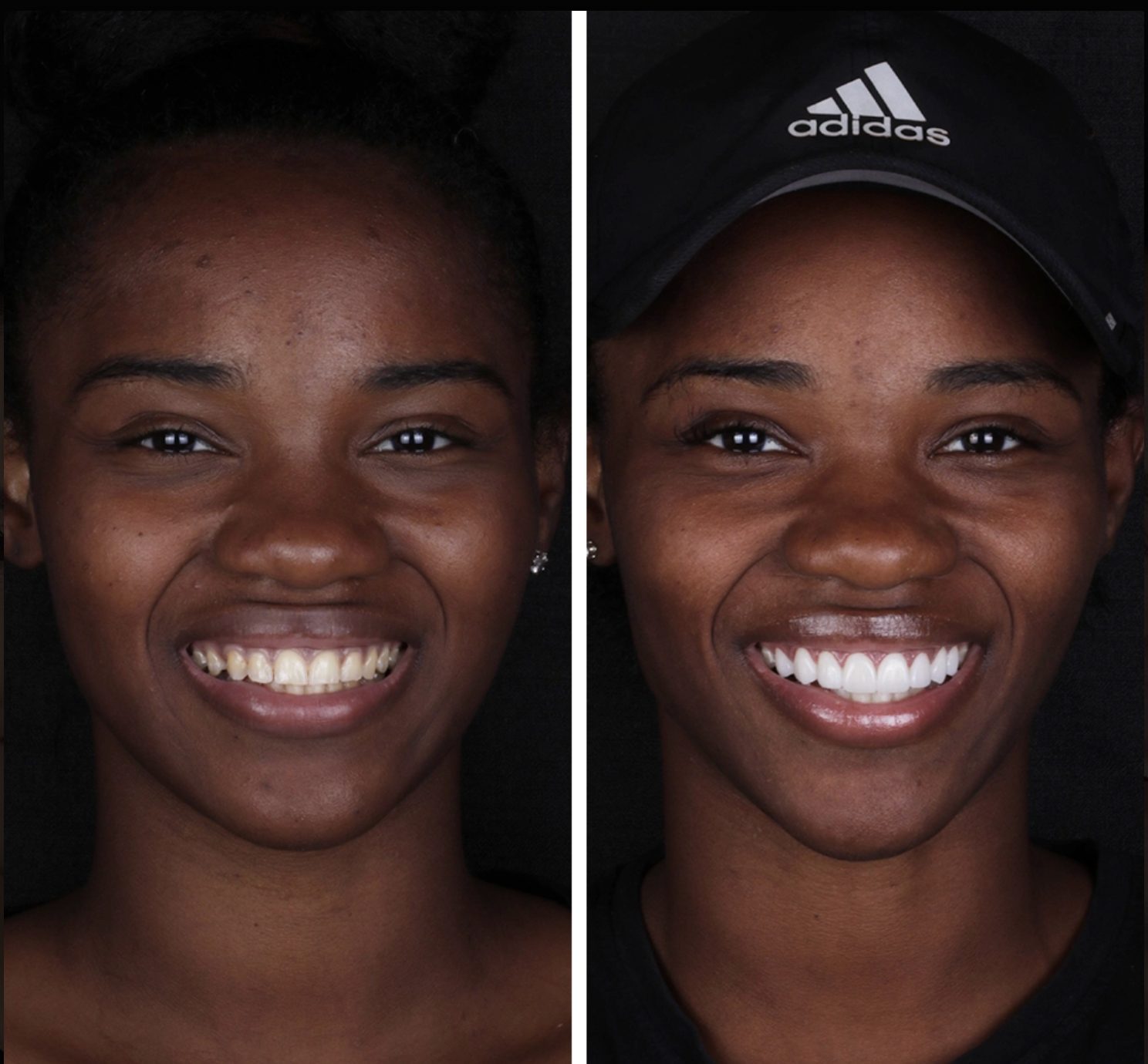 Antes y después Carillas · Estética Dental — Clínica Doctores Romero