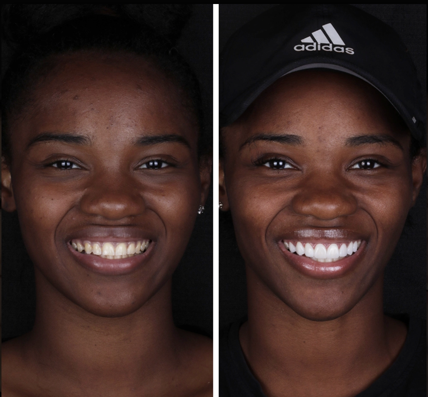 Antes y después Carillas · Estética Dental — Clínica Doctores Romero