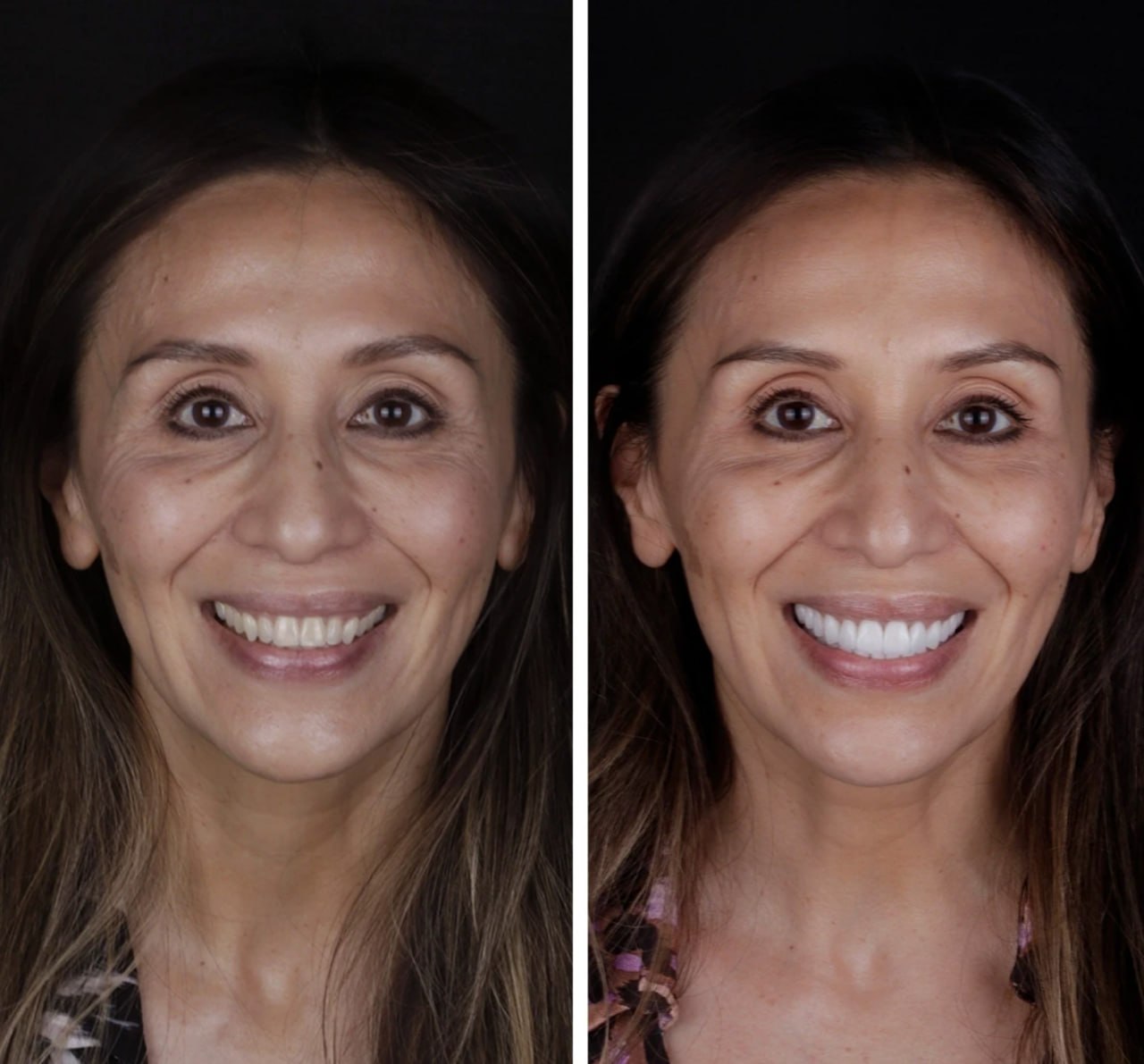 Tercer caso real de ortodoncia invisible en Doctores Romero Madrid: alineación y blanqueamiento progresivo