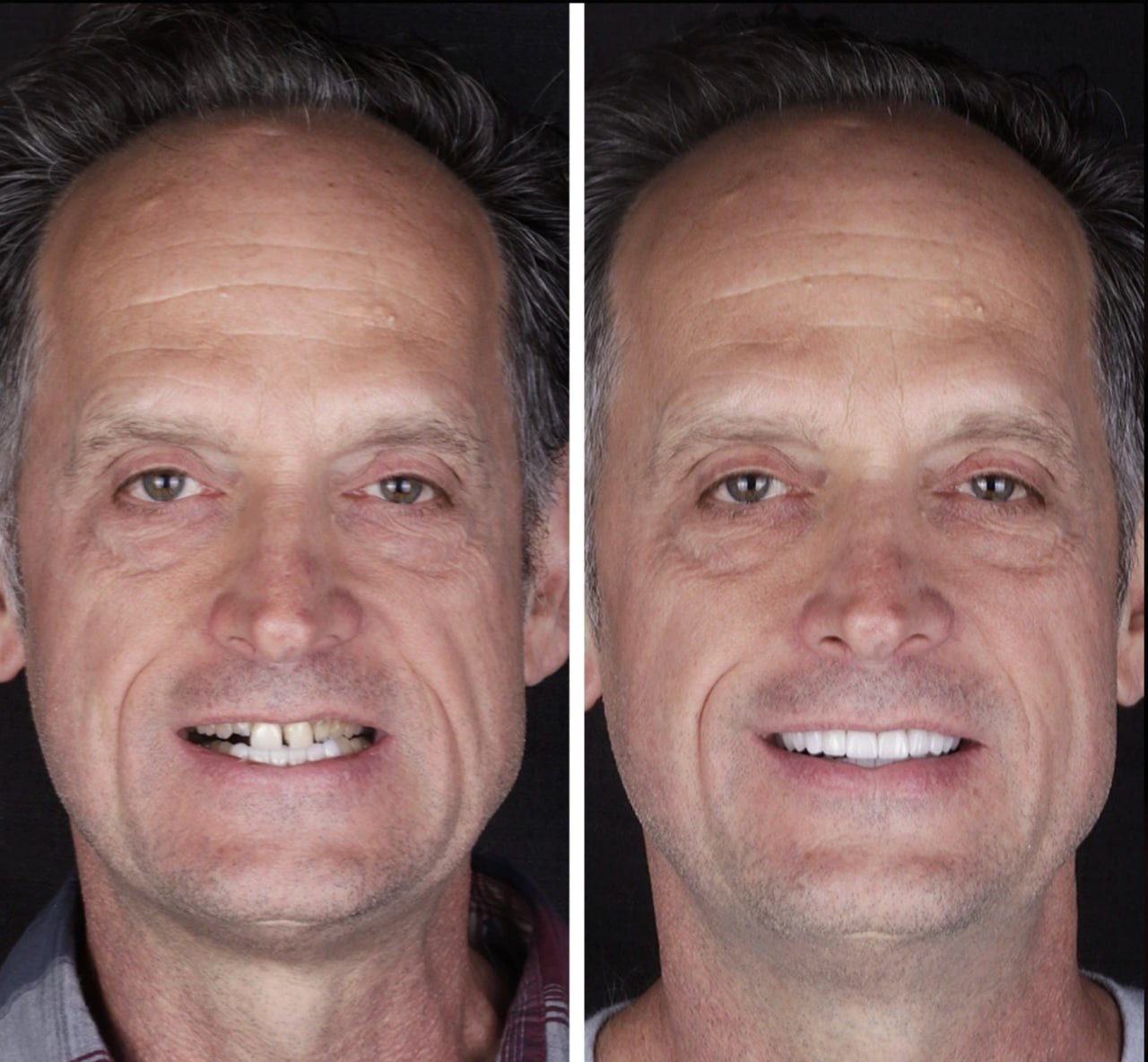 Otro caso real de carillas dentales tratado en Doctores Romero Madrid, antes y después