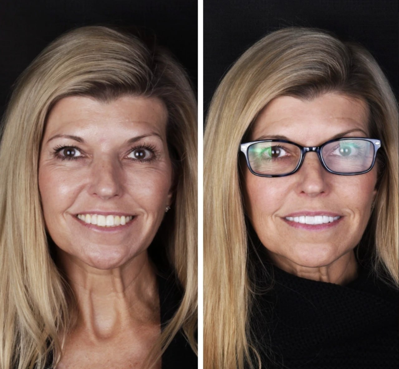 Tercer caso real de carillas dentales en Doctores Romero Madrid, cambio de color y forma